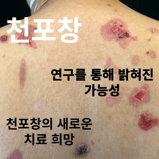 천포창 환자들에게 일상은 종종 도전의 연속입니다. 하지만 최근 연구를 통해 천포창 치료에 새로운 빛이 비추고 있습니다. 이 글을 통해 그 가능성을 함께 탐구해보시기 바랍니다.