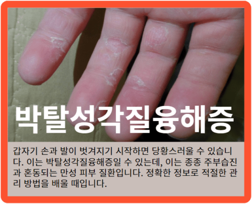 갑자기 손과 발이 벗겨지기 시작하면 당황스러울 수 있습니다. 이는 박탈성각질융해증일 수 있는데, 이는 종종 주부습진과 혼동되는 만성 피부 질환입니다. 정확한 정보로 적절한 관리 방법을 배울 때입니다.