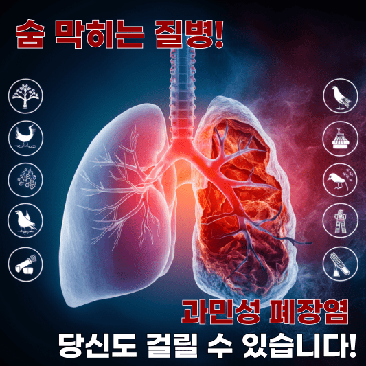 오늘은 우리 몸의 소중한 기관인 폐에 영향을 미치는 숨겨진 질병, 과민성 폐장염에 대해 알아보려 합니다. 과민성 폐장염은 폐에 영향을 미치는 희귀 면역 질환으로, 특정 유기 먼지나 곰팡이에 대한 과민 반응으로 인해 폐 내 공기 공간(폐포)과 작은 기도(세기관지)에 염증이 발생합니다. 마치 알레르기 반응과 비슷하다고 생각하시면 됩니다.
