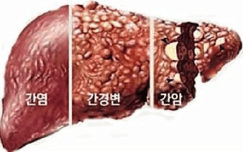 알코올성 간경변증